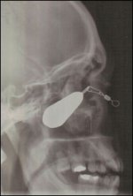 fishing_injury5.jpg
